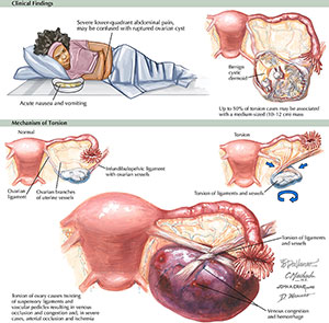 Ovarian Torsion