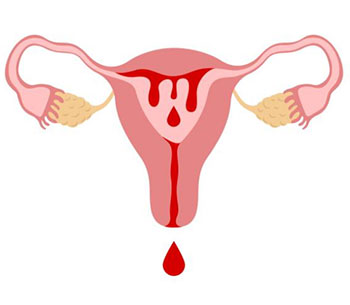 Heavy Menstrual Bleeding