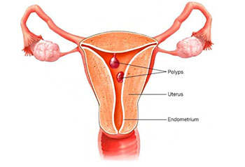 Endometrial Polyp