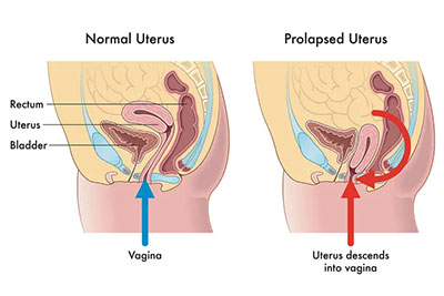Pelvic Organ Prolapse