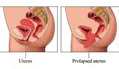 Pelvic Organ Prolapse