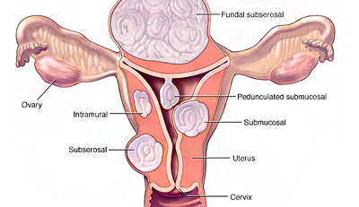 Fibroids