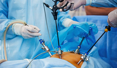Laparoscopic Surgery