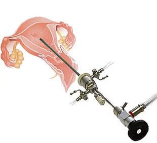 Hysteroscopic Surgery