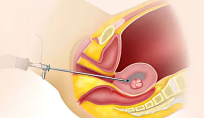 Hysteroscopic Surgery