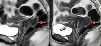 Endometriosis Diagnosis