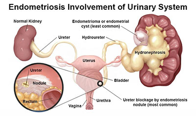 Bladder Endometriosis