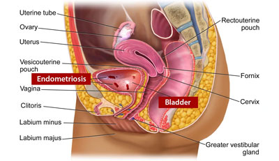 Bladder Endometriosis