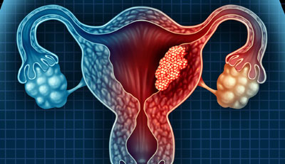 Oncology & Gynecologic Cancer