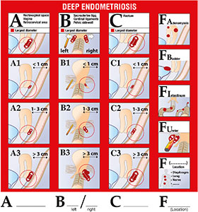 Deep Infiltrating Endometriosis