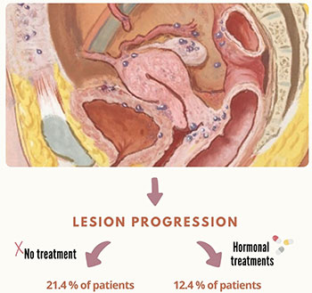 Deep Infiltrating Endometriosis