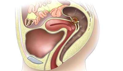 Deep Infiltrating Endometriosis