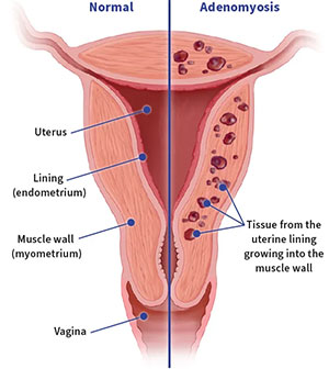 Adenomyosis