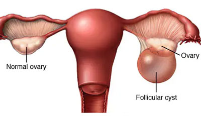 Ovarian Cyst