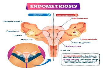 Best Doctor for Endometriosis in Vile Parle